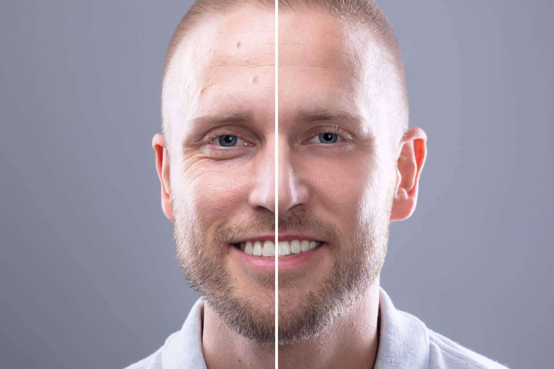 El plasma láser de Alluring Clinic para la blefaroplastia sin cirugía