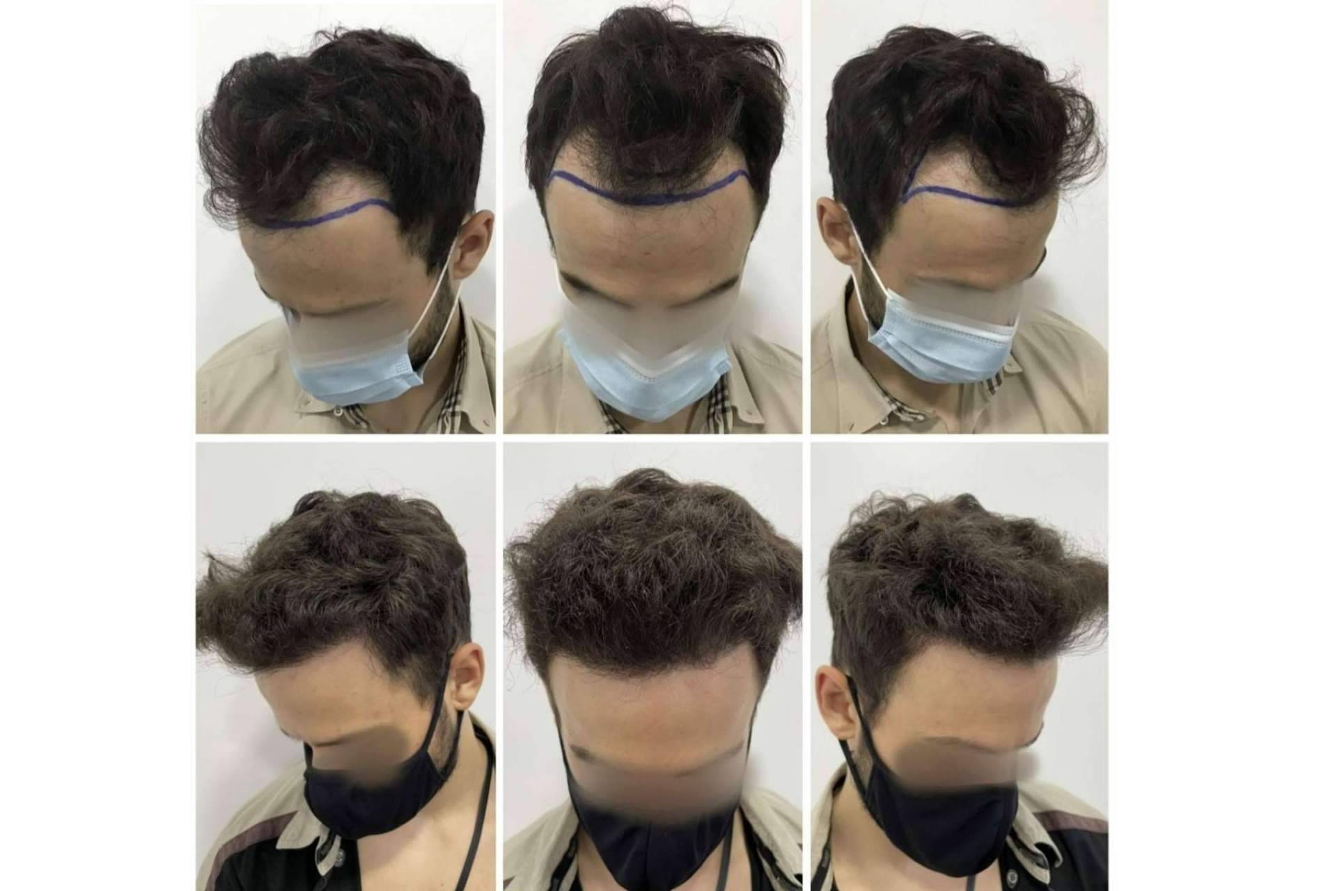 El Dr. Bruno Jacobovski expone los efectos secundarios de un injerto capilar